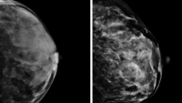 Two mammograms showing the same density but different textures in breast tissue